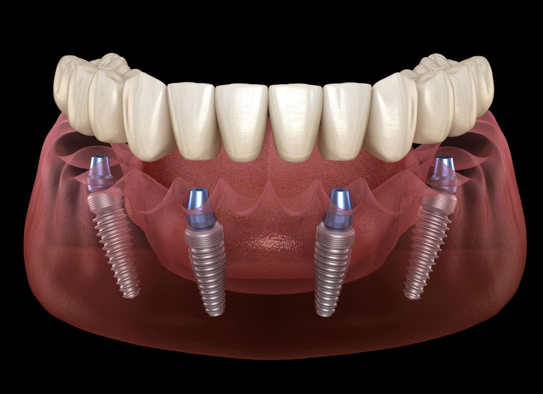 All-On-4 Dental Implants Falls Church, VA