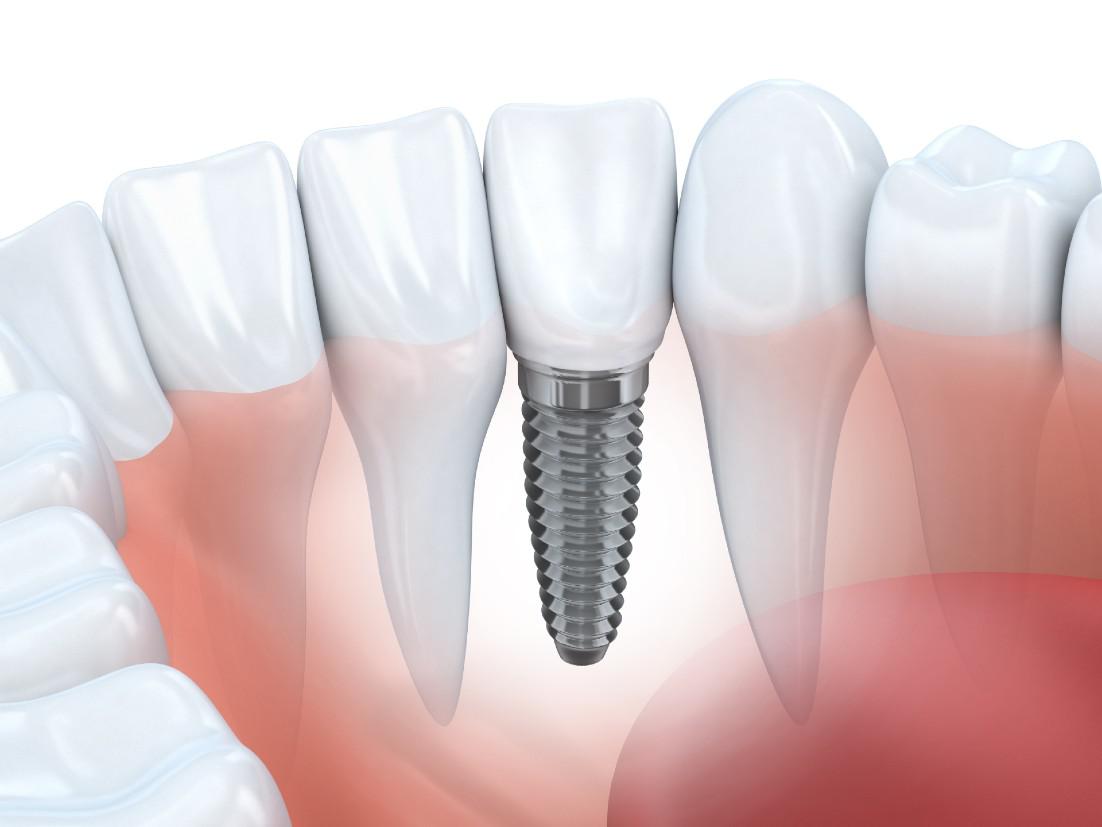 Dental Implants Falls Church, VA